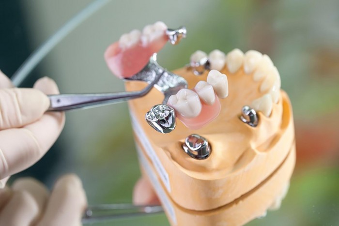 Teleskopprothese mit den sogenannten Teleskopkronen Teleskopprothese mit den sogenannten Teleskopkronen